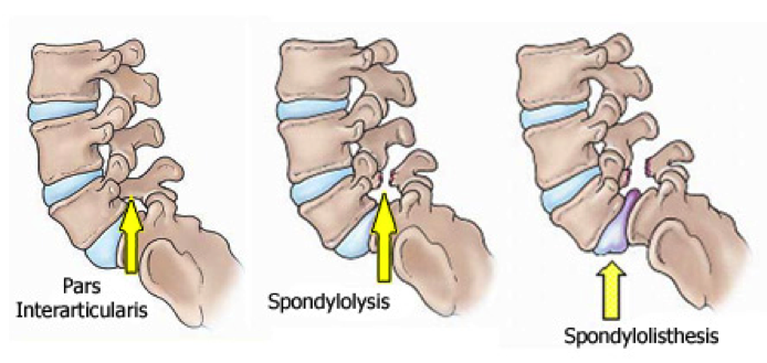How i cured my spondylolisthesis naturally image