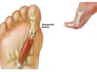 Sesamoiditis