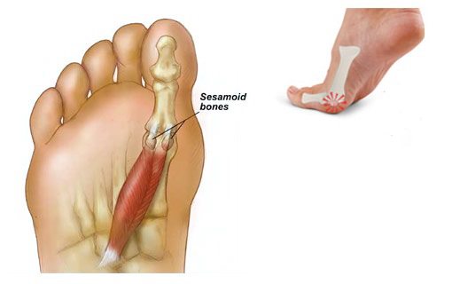 Sesamoiditis